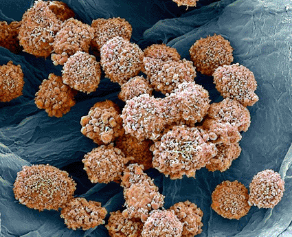 Image: Colored scanning electron micrograph (SEM) of breast cancer cells (photo courtesy Steve Gschmeissner / SPL).